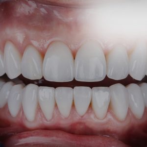 Limpieza Dental Full